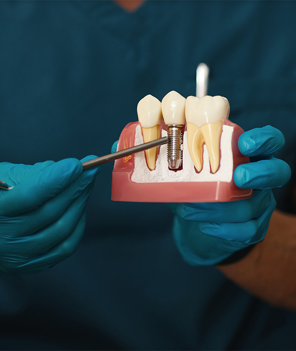 İmplant Sonrası Beslenme Nasıl Olmalı?