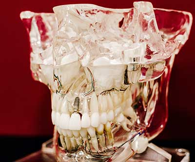 Şeffaf Plak Ortodonti