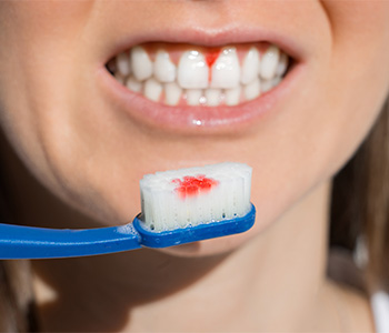 Diş Eti Kanamalarına Dikkat! Gizli Seyreden Hastalıkların Belirtisi Olabilir